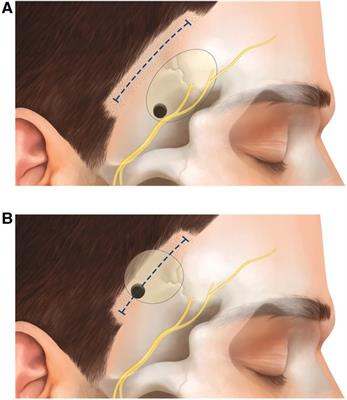 The sylvian keyhole approach for surgical clipping of middle cerebral artery aneurysms: Technical nuance to the minipterional craniotomy
